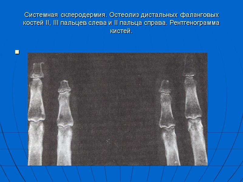Системная склеродермия. Остеолиз дистальных фаланговых костей II, III пальцев слева и II пальца справа.